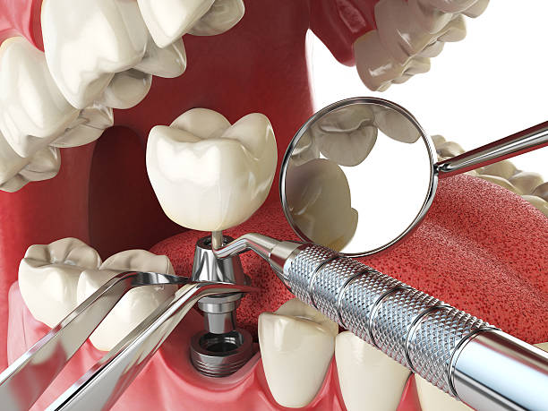 Best Walk-In Emergency Dentist in Mission, SD